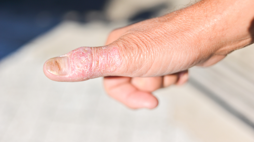 Kartläggningen av psoriasisartitgen ett genombrott i psoriasisforskningen